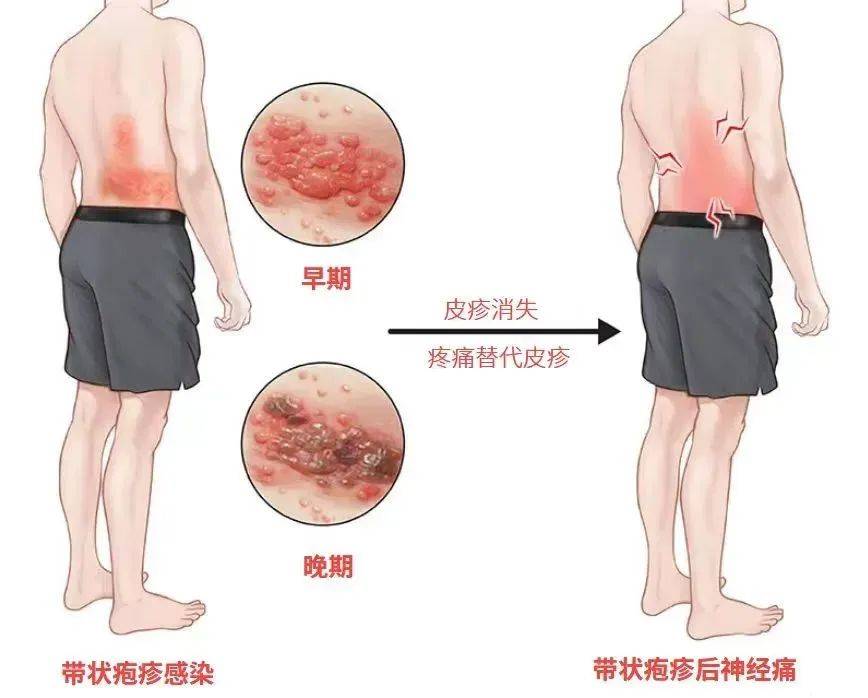 一旦感染终身携带<strong></p>
<p>打制币</strong>！深圳疾控提醒：这4类人要注意