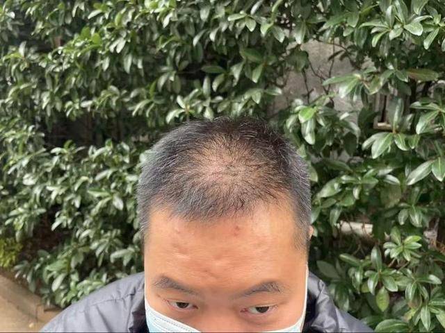 “还能反光<strong></p>
<p>坐以待币</strong>！”长沙男子植发近9月称后脑勺“像狗啃过”