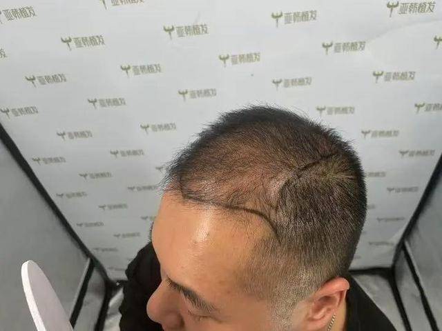 “还能反光<strong></p>
<p>坐以待币</strong>！”长沙男子植发近9月称后脑勺“像狗啃过”