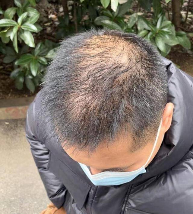 “还能反光<strong></p>
<p>坐以待币</strong>！”长沙男子植发近9月称后脑勺“像狗啃过”