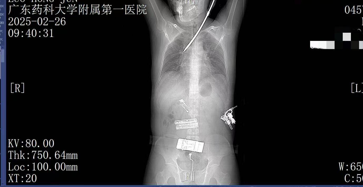 20米高空掉落螺丝刀直插男子胸腔<strong></p>
<p>炒币秘籍</strong>！医生：不要自行拔除