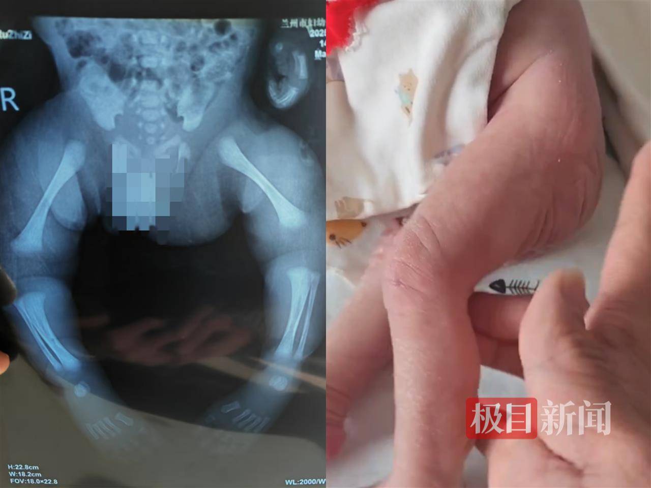 二胎出生查出先天性病症或落下残疾<strong></p>
<p>币圈入门</strong>，残疾父母称医院产检漏检、未尽告知义务，医院及医调委回应