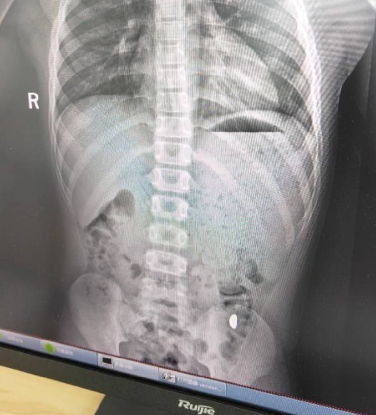 “熊孩子”误吞10克重金豆<strong></p>
<p>币圈神话</strong>,妈妈:天天叮嘱他不要在外面拉屎