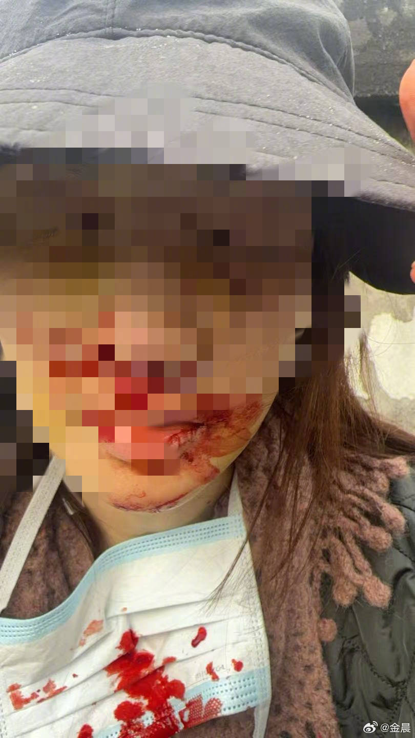 警方发布警情通报后<strong></p>
<p>碳币</strong>，金晨晒脸部受伤照片并发文道歉