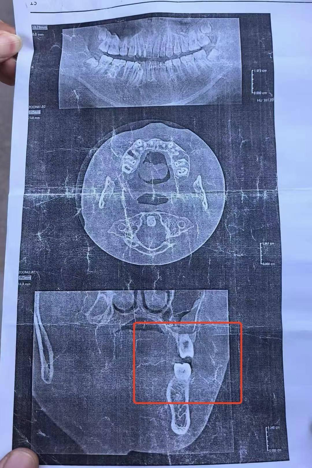 初三男生与体育老师发生冲突面部被打骨折<strong></p>
<p>广西币圈</strong>，校方：已开除涉事老师，正协商赔偿事宜