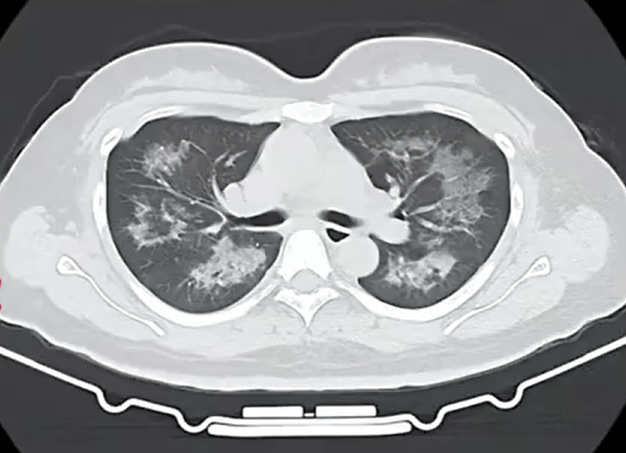 每天用2次<strong></p>
<p>币圈行业术语</strong>，22岁女主播肺里长满阴影！很多人不注意