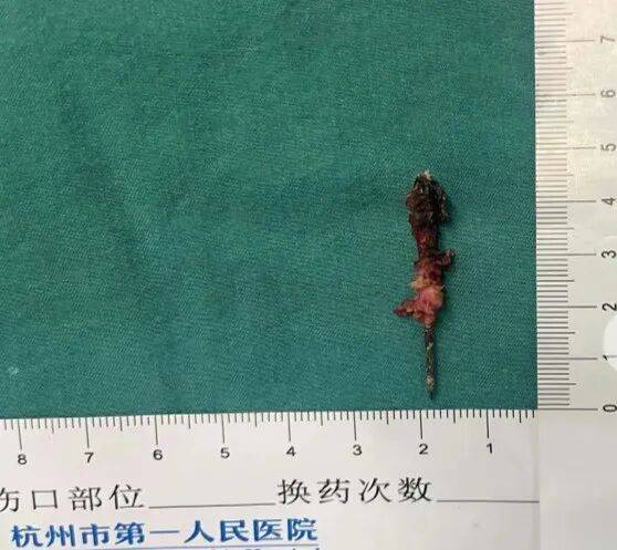 17岁小伙参军体检发现胸腔内有根5cm缝衣针<strong></p>
<p>币圈社区介绍</strong>，父母回忆或是1岁时扎入，取出时已锈迹斑斑